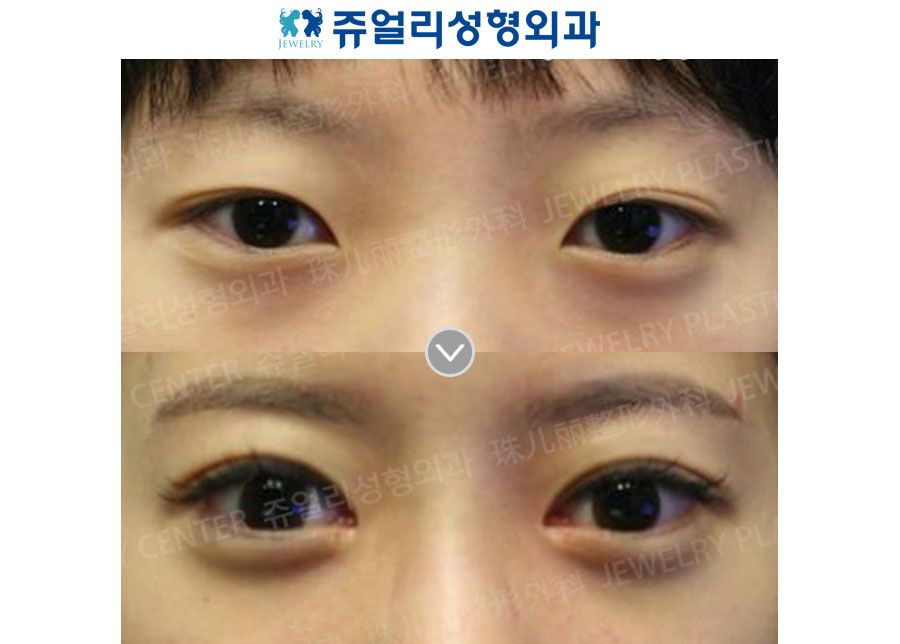 Double Eyelids Non-Incision