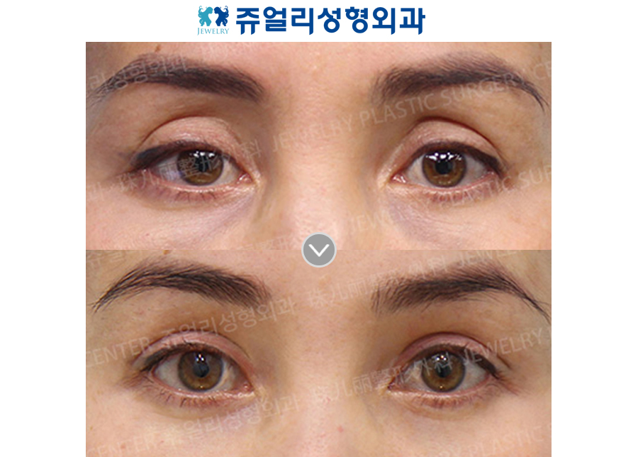 Double Eyelids Reoperation (Ptosis)+ Upper Eyelid Fat Grafting + Lower Blepharoplasty