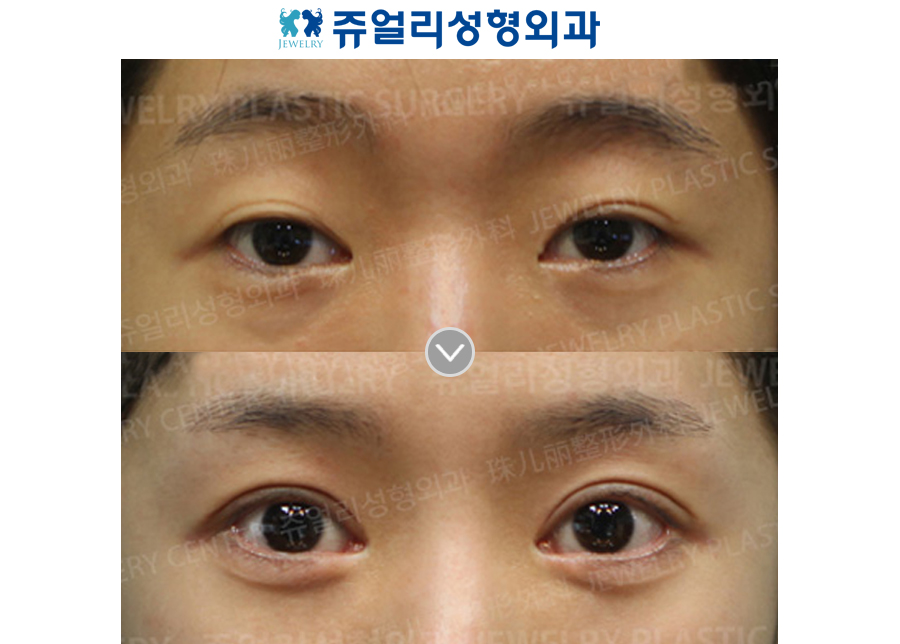 Incision Reoperation + Ptosis