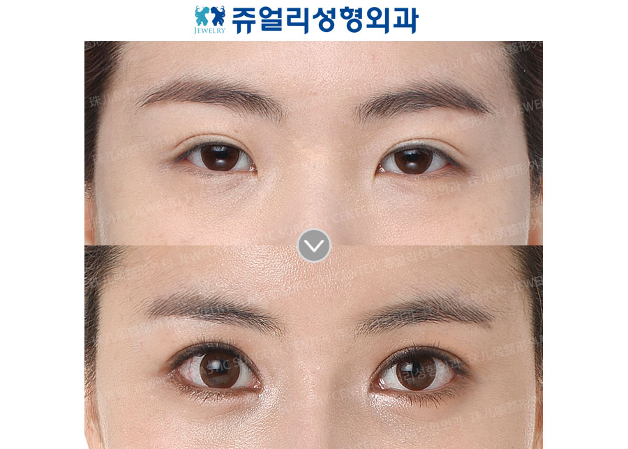 Ptosis Correction + Ptosis