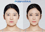 Double Eyelids (Non-Incision), Fat Repositioning Transconjunctival Blepharoplasty, Filler Removal, Nose Reoperation, Liposuction (Double Chin+Cheek), Fat Grafting 2 time (Forehead+Cheek), Facial Contour (Cheekbone, Square Jaws & Front Chin Reduction)