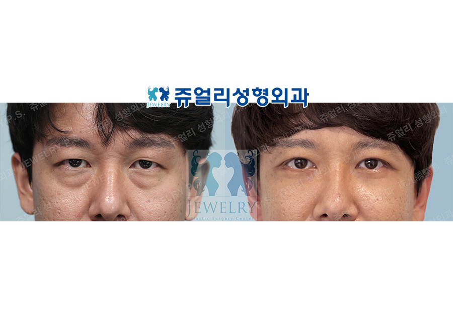 Upper+Lower Blepharoplasty