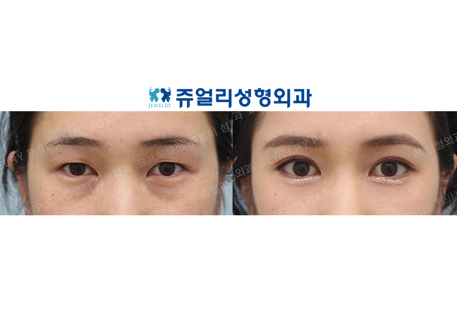 Double Eyelid, Dark Circle (Fat-Repositioning Transconjunctival Blepharo, Loveband X), Lower Lateral Canthoplasty/Lowering down the eyes tail