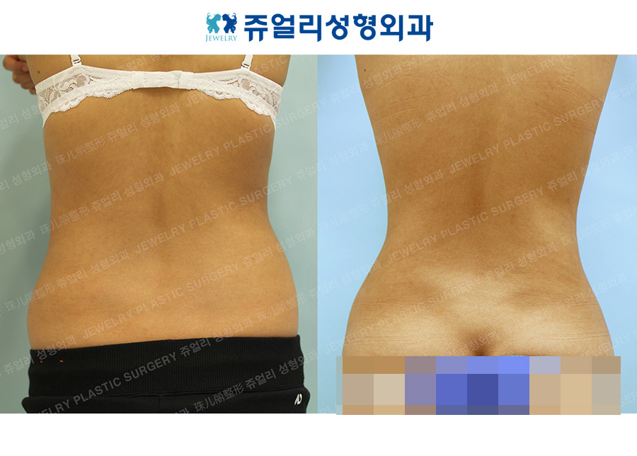 Liposuction (Whole Abdomen)