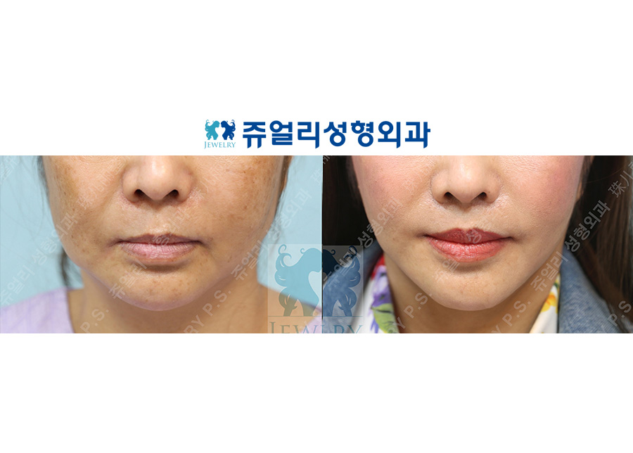 Philtrum reduction + C-curl Philtrum
