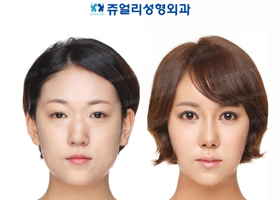 Eyes Surgery+Nose Surgery+Fat Grafting+Chin Botox