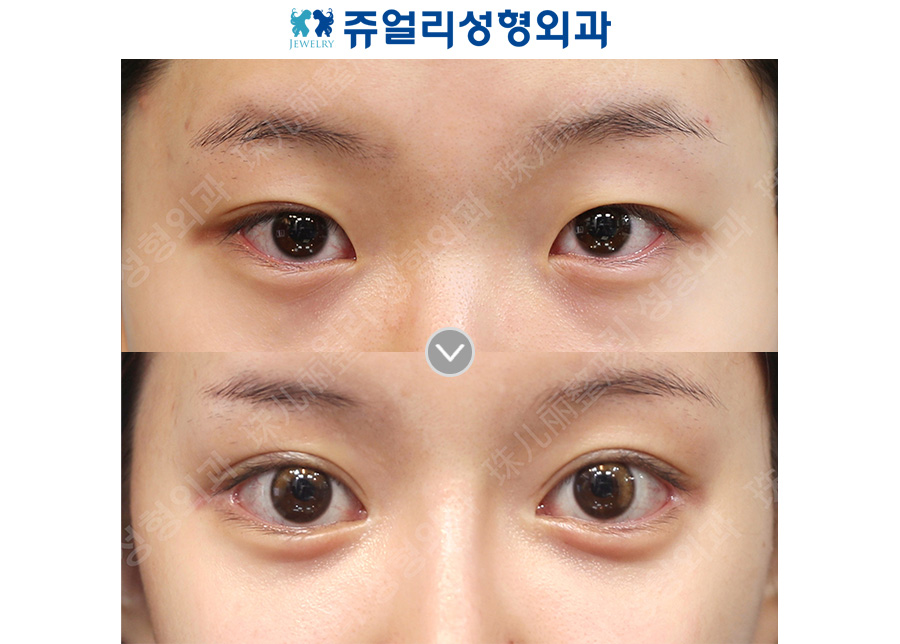 Double eyelid surgery + epicanthoplasty, lateral canthoplasty, lower canthoplasty + under-eye fat repositioning + aegyo-sal