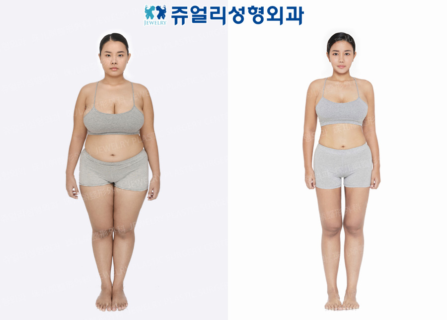 Whole Body Liposuction, Calf Size Reduction High Frequency, Breast Size Reduction