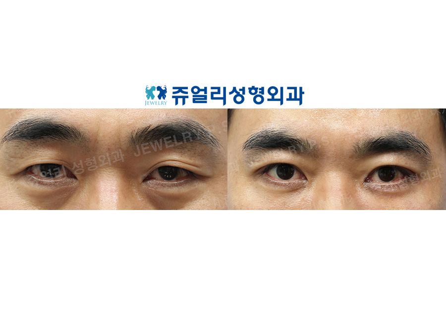 Double Eyelid (Non-Incision, Ptosis Correction), Dark Circle Removal