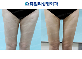 Thigh Liposuction