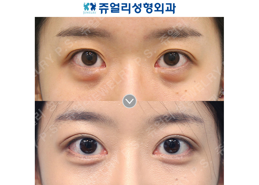 Revision double eyelid surgery + under-eye fat repositioning + aegyo-sal (dissolving existing filler) + epicanthoplasty, lateral canthoplasty, lower canthoplasty