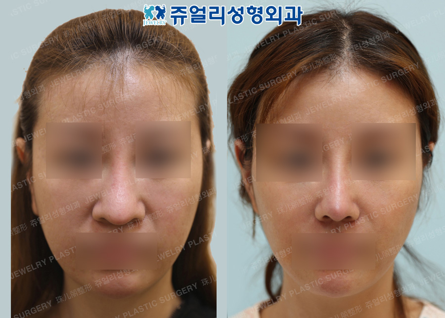 Nose Reoperation (Autogenous Rib Cartilage, Osteotomy), Nostrils Reduction