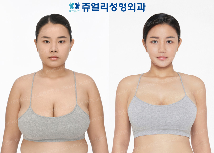 Breast Reduction