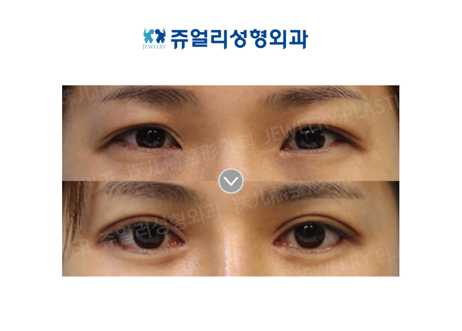 Double Eyelids, Epi+Lateral+Lower Lateral Canthoplasty