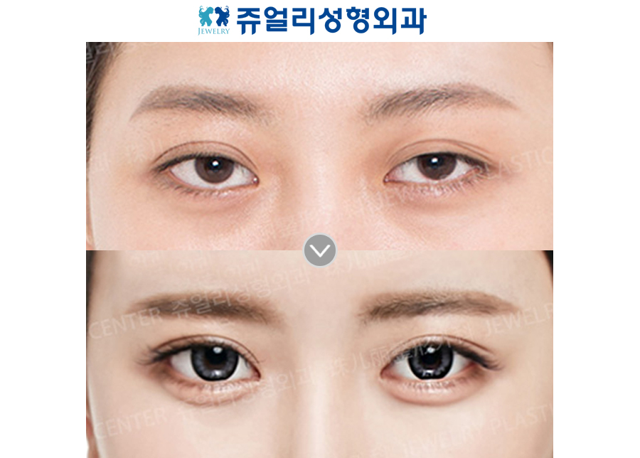 Double Eyelids Incision