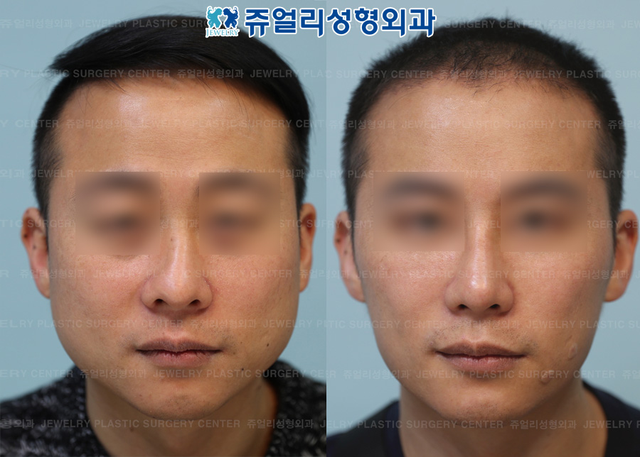 Nose Surgery + Chin Implant