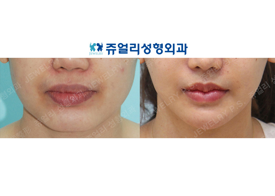 Lip Reduction (M-shaped lips), Corner Lip Lift