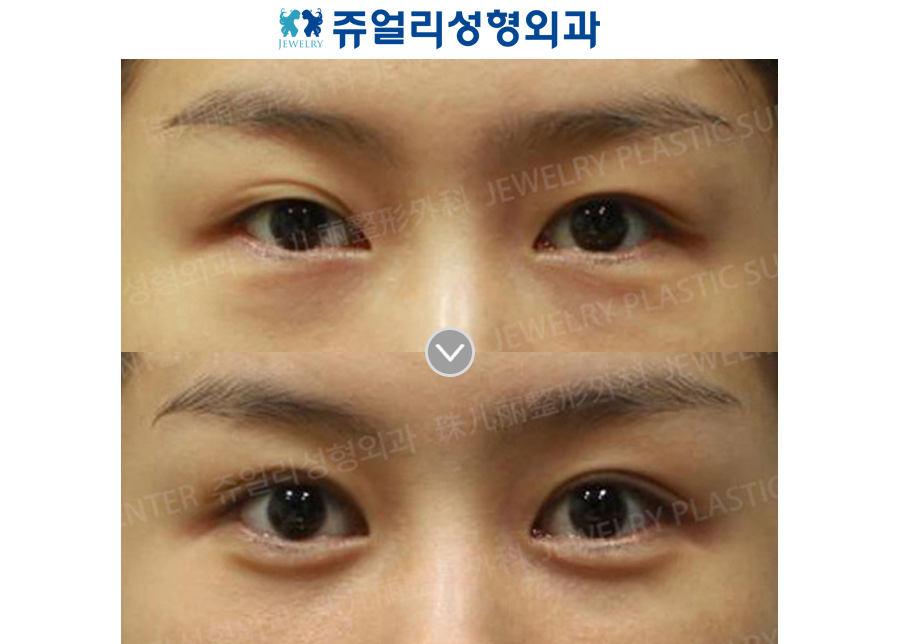 Double Eyelids Non-Incision