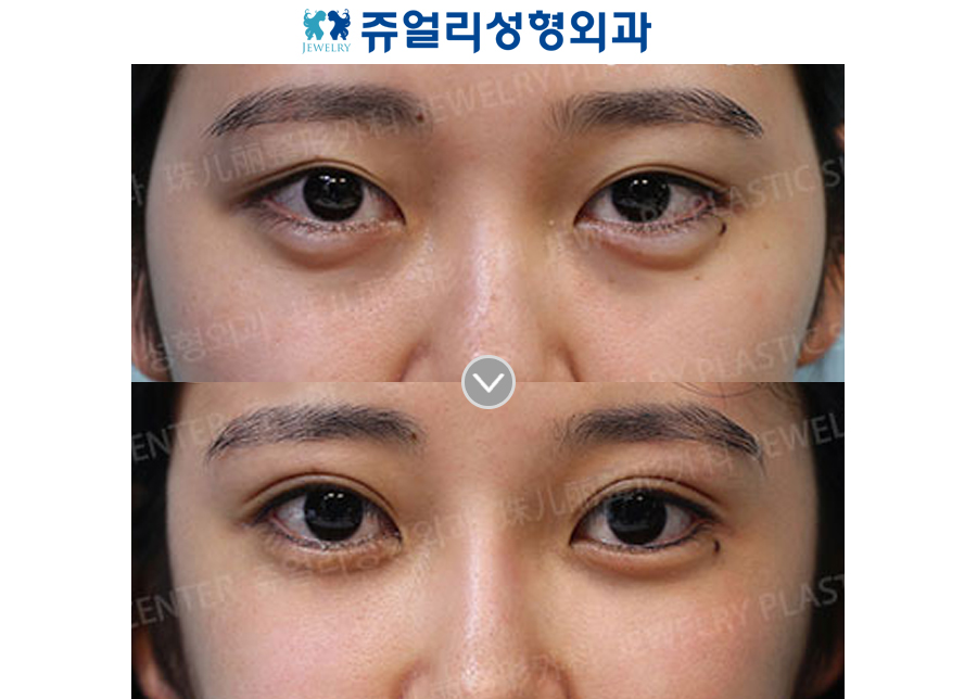 Double Eyelids (Non-Incision) + Dark Circle (Filler Removal + Fat-Repositioning Transconjunctival)
