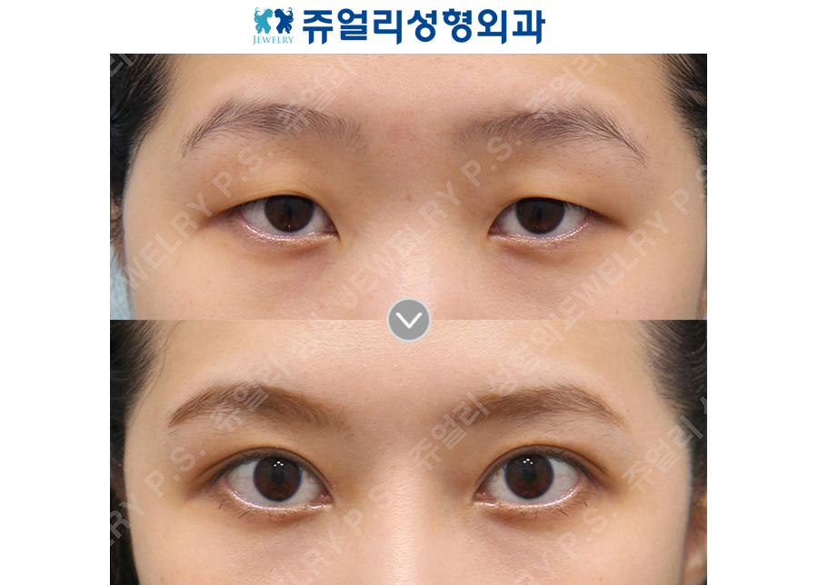Double Eyelids (Eyes Enlargement)+Epicanthoplasty