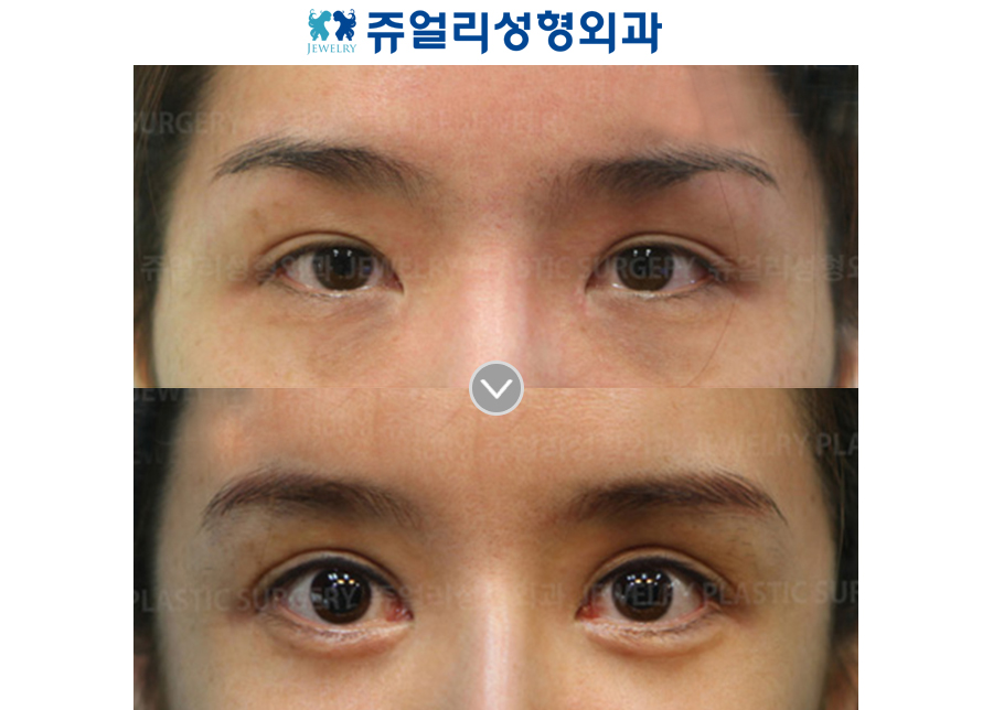 Ptosis Correction + Ptosis