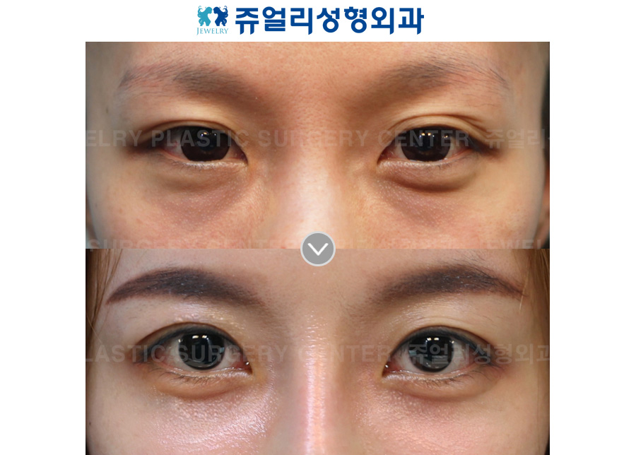 Ptosis + Dark Circle Removal (Fat-Repositioning)