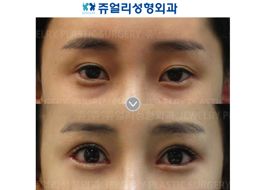 Incision Reoperation + Ptosis