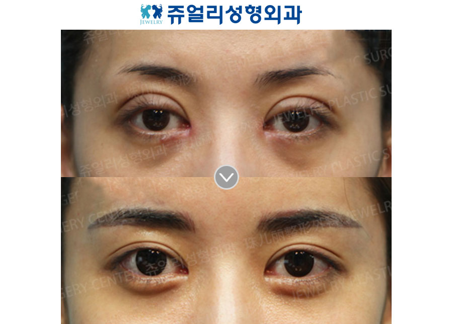 Incision Reoperation + Ptosis