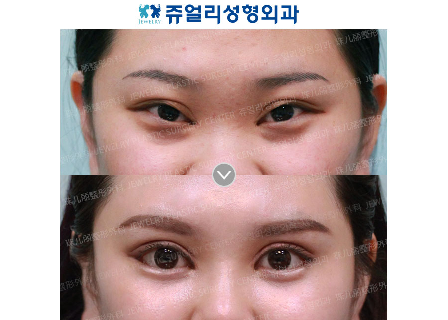 Ptosis (Eyes Enlargement)+Lateral Canthoplasty+Eyes Tail (Lower Lateral Canthoplasty)