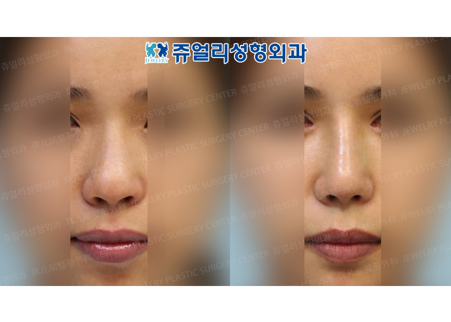 Nose Surgery