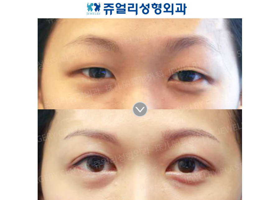 Double Eyelids Non-Incision