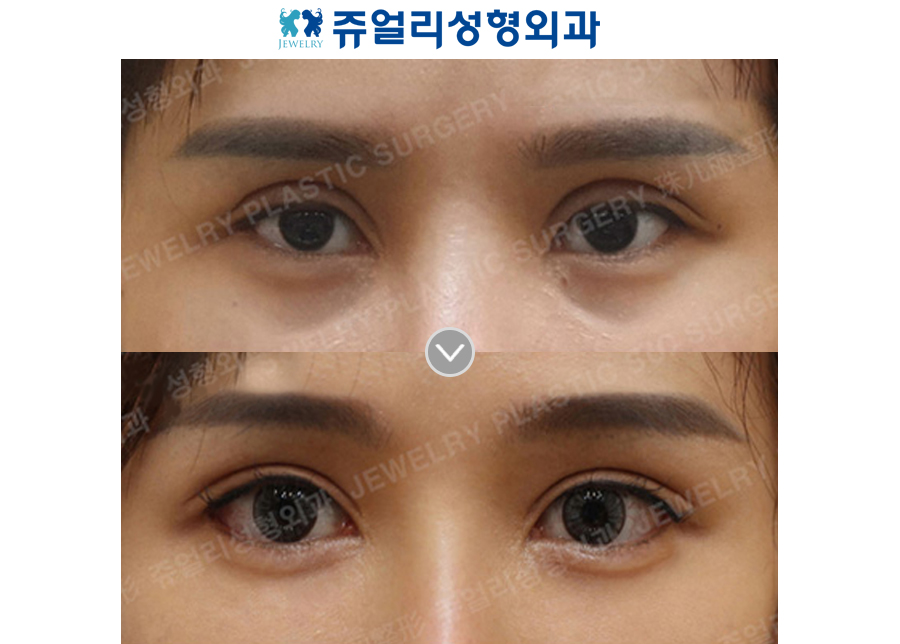 Ptosis, Double Eyelids, Lateral + Lower Lateral Canthoplasty, Fat-Repositioning Transconjunctival (Loveband)