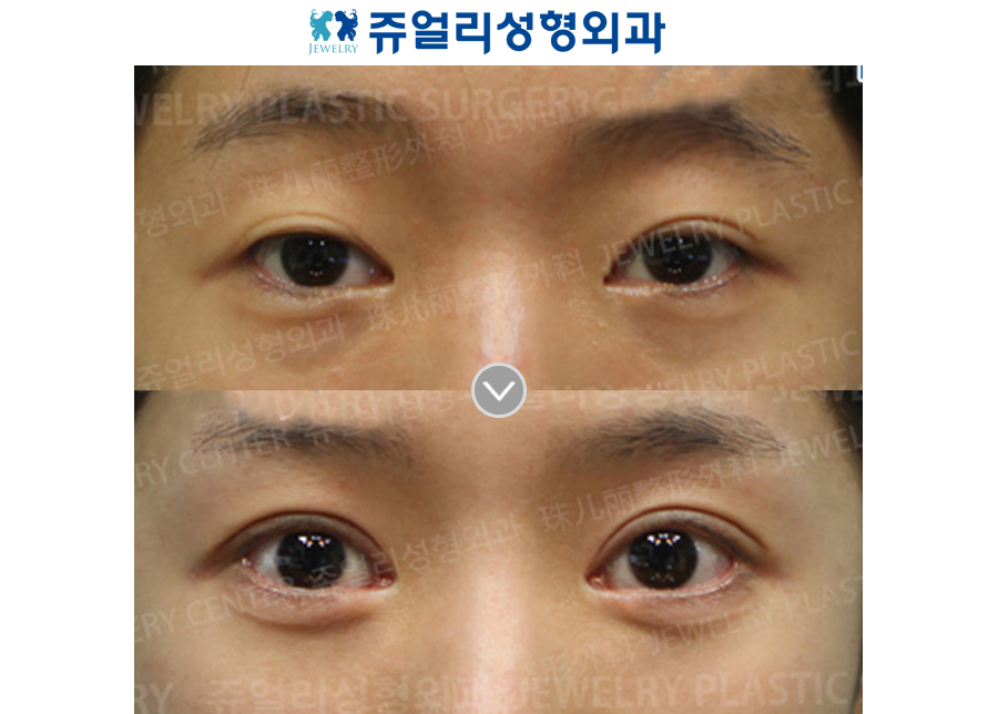 Ptosis Correction + Ptosis
