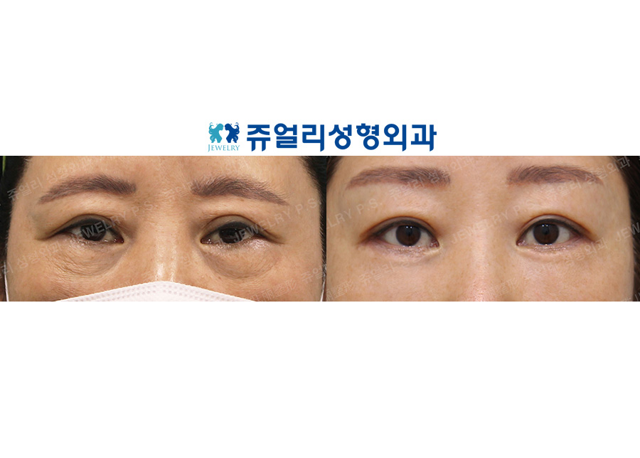 Lower Blepharoplasty Reoperation