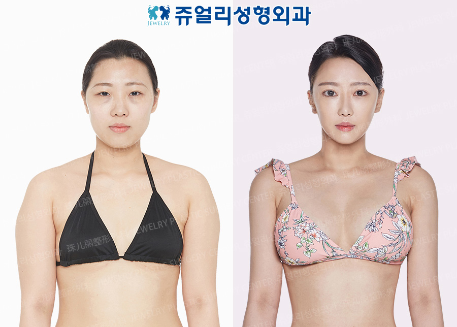 Breast Augmentation, Liposuction (accessory breast liposuction, arm, abdomen, flank, back, thigh, armpit)