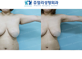 Arm Liposuction