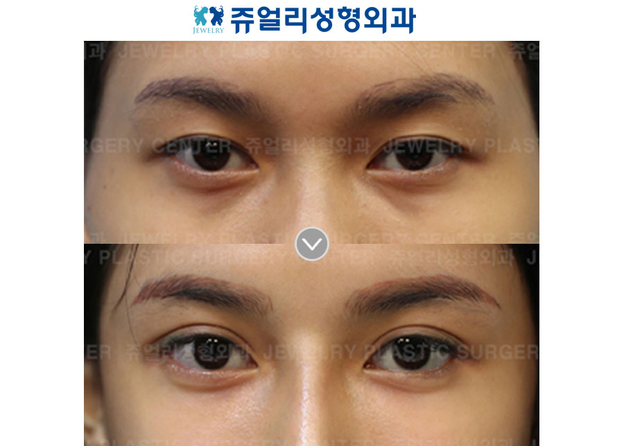 Non-Incision, Lateral Canthoplasty + Lower Lateral Canthoplasty+ Fat-Repositioning Transconjunctival Blepharoplasty