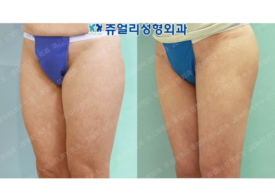 Thighs Liposuction + Hip Up (Fat Grafting)