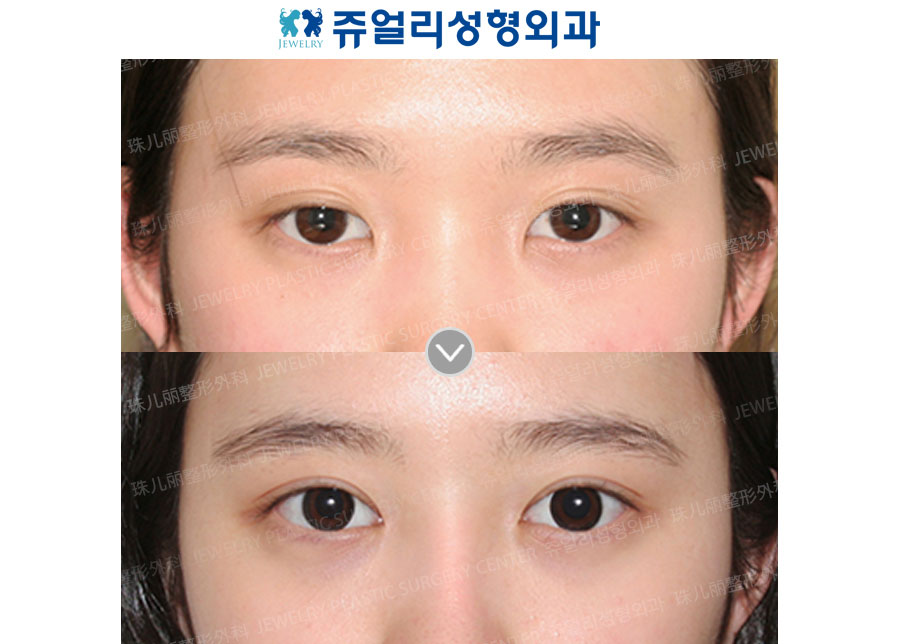 Double Eyelids