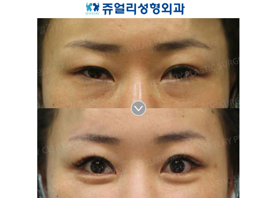 Fat-Repositioning Transconjunctival + Loveband