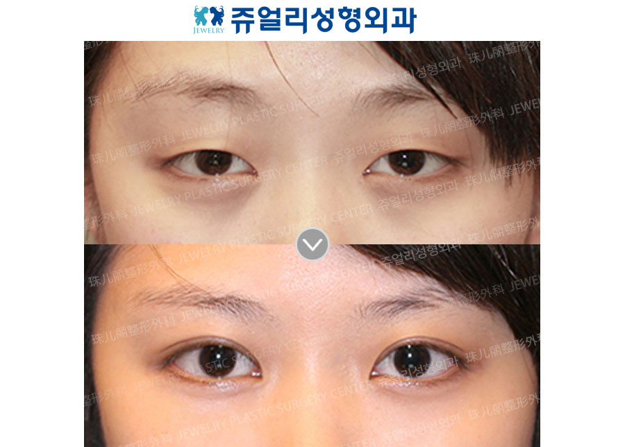 Double Eyelids + Dark Circle (Fat-Repositioning Transconjunctival)