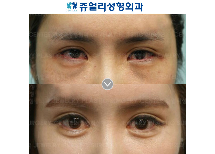 Ptosis + Epicanthoplasty + Lateral Canthoplasty + Lower Lateral Canthoplasty + Dark Circles + Loveband