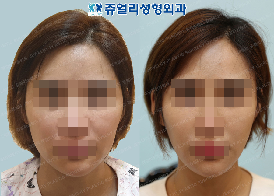 Cheekbone+Square Jaw Reduction+T-osteotomy