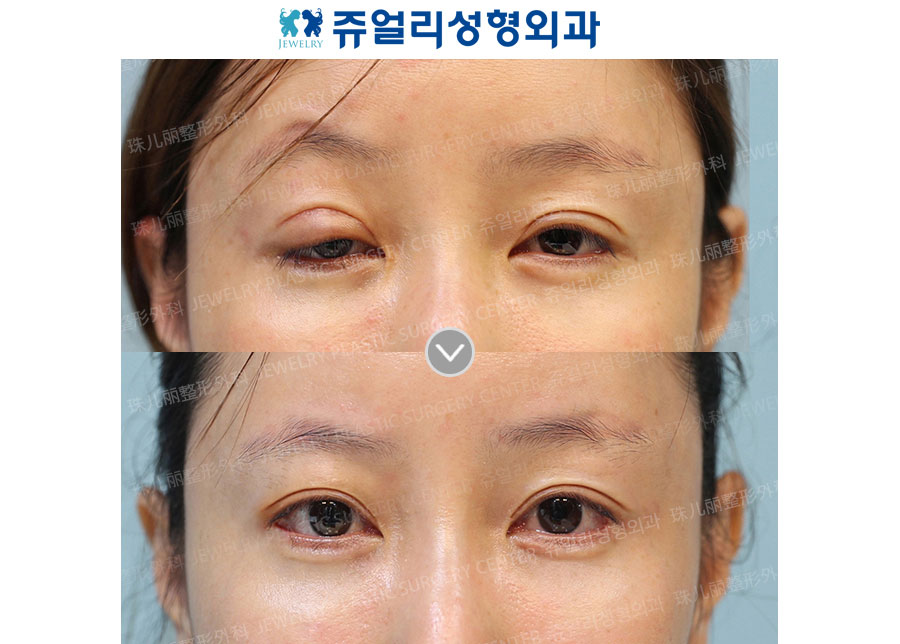 Eyes Reoperation (Ptosis side-effect occured)