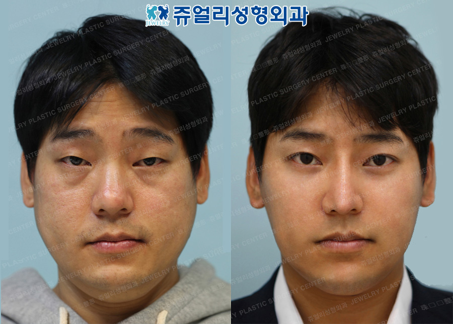 Non-Incision Ptosis Correction, Dark Circle, Nose, Cheek + Jaw Liposuction, Jaw Botox