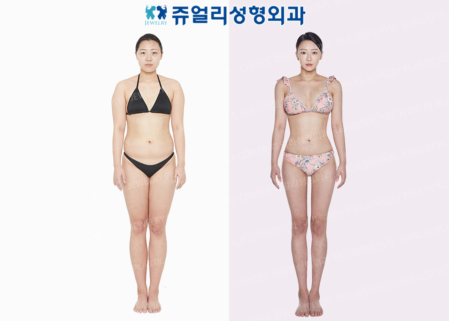 Breast Augmentation, Liposuction (accessory breast liposuction, arm, abdomen, flank, back, thigh, armpit)