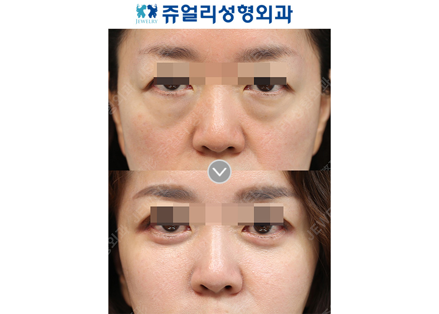 Lower blepharoplasty + midface lift