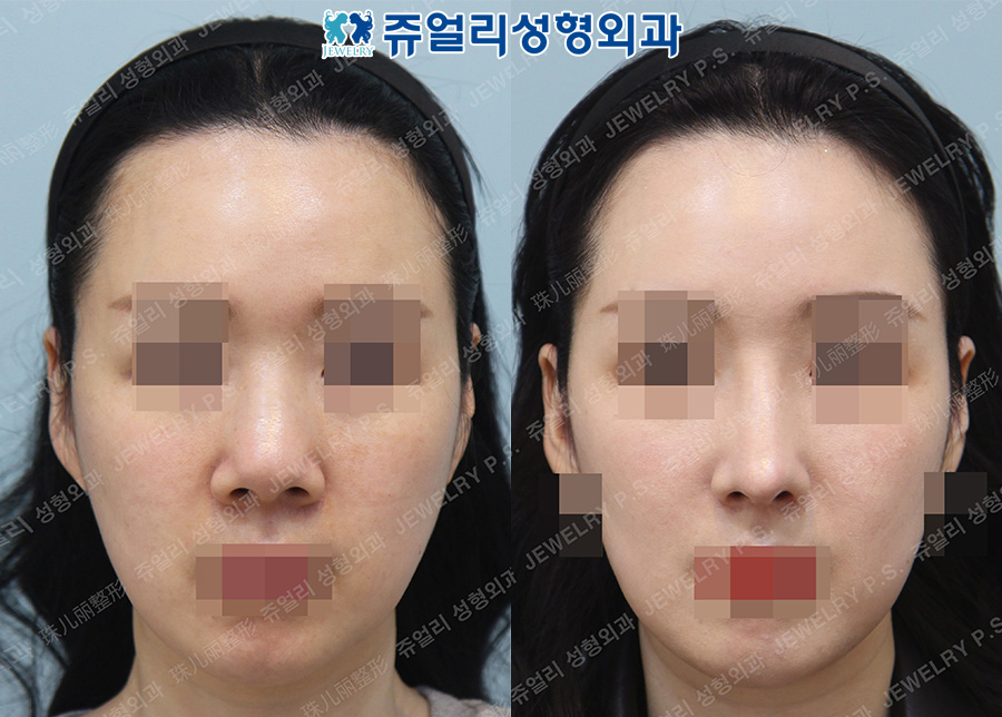 Rhinoplasty (Hump Removal, Extend Length), Nostrils Reduction