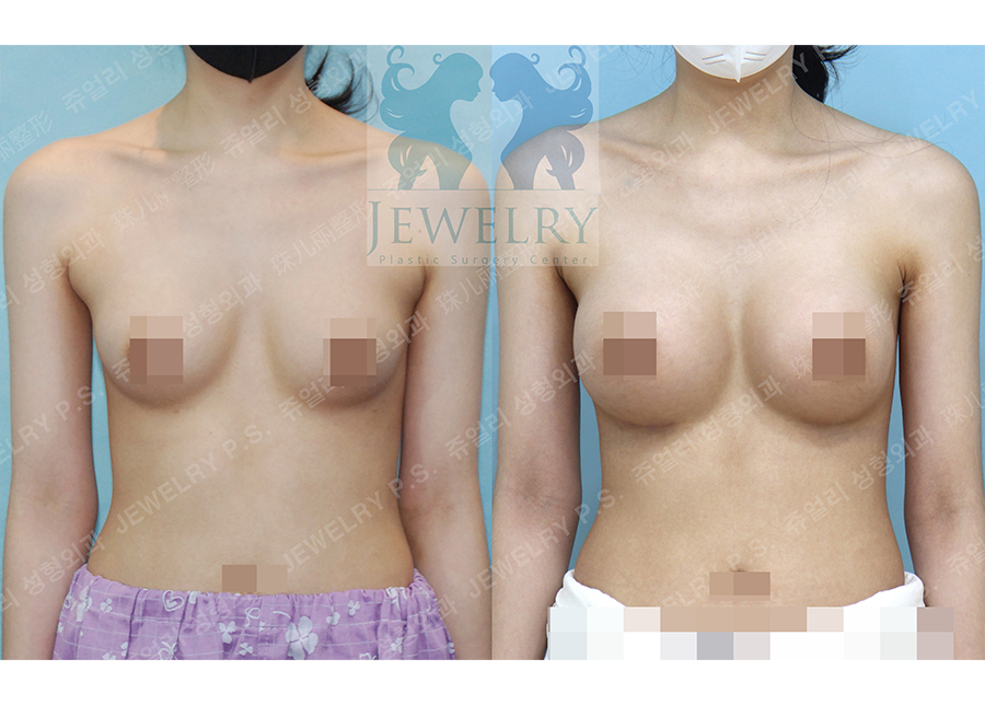 Breast Augmentation (Under Breast Incision) 325cc right and left