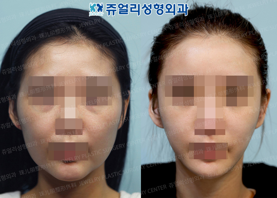 Cheekbone Reduction + Square Jaws Reduction + Front Chin Reduction